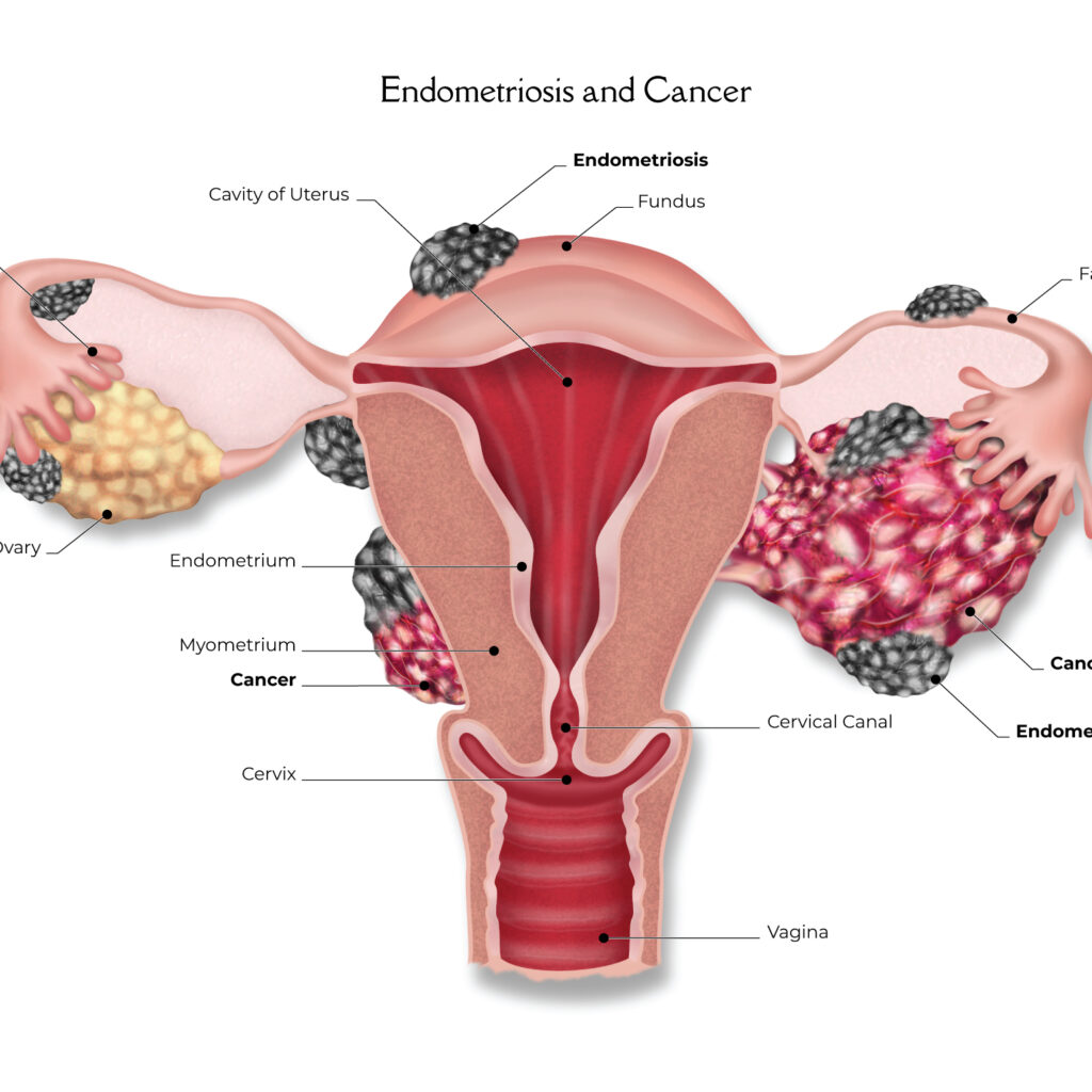 Endometriosis_Cancer-2000px