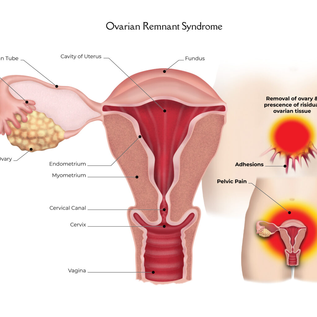 Ovarian_Remnant_Syndrome-2000px